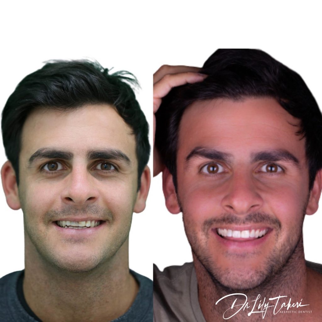 porcelain veneer perth - before after