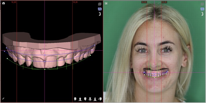 Digital smile design test drive - Yhe Applecross Dentist