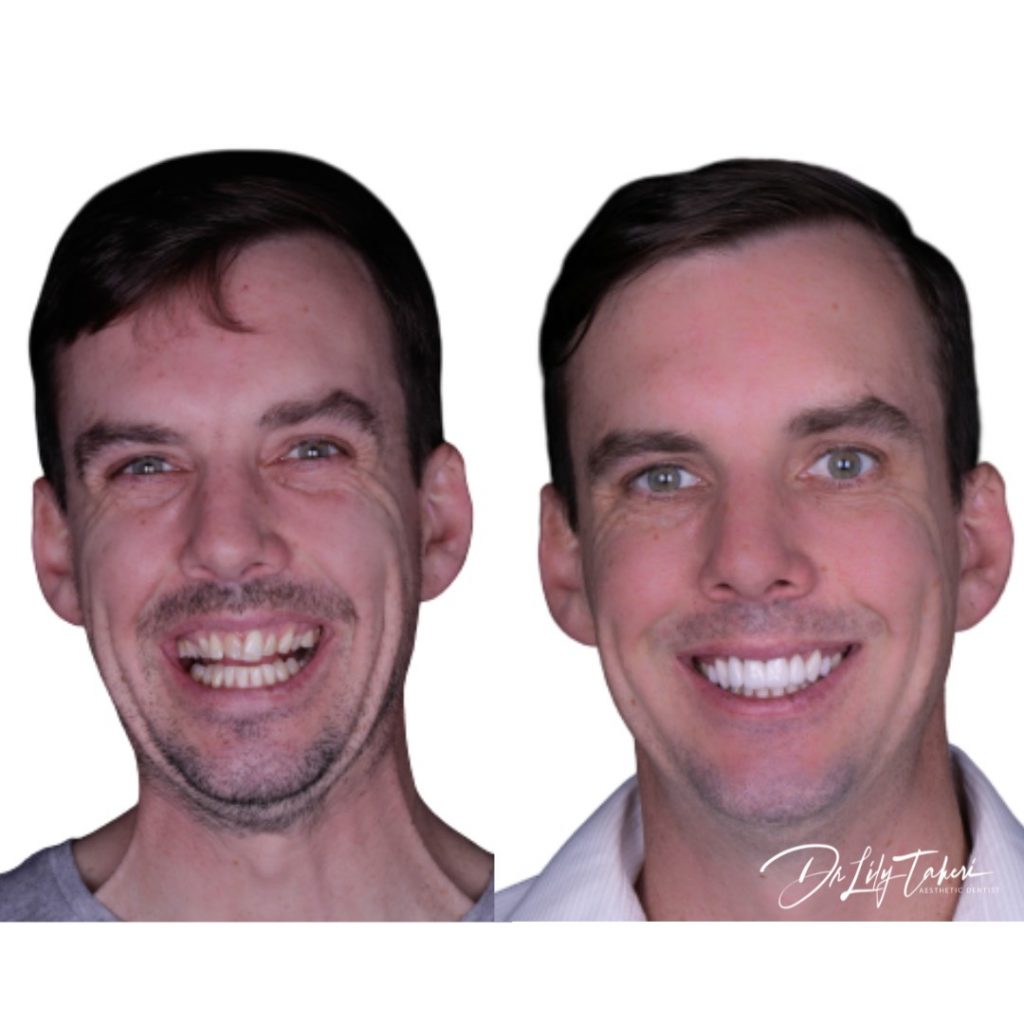 Porcelain Veneers with Digital Smile Design - The Applecross Dentist
