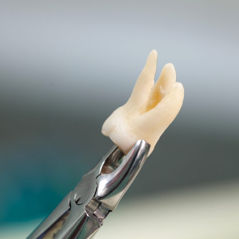 Wisdom teeth removal Applecross