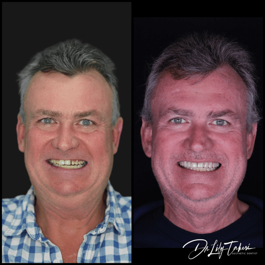 The Applecross Dentist - Before After Dental Veneers Perth WA