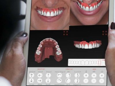 Best Cosmetic Dentist Applecross, Digital Smile design Perth