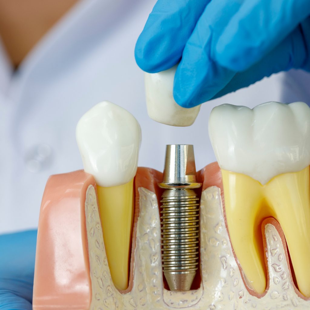 Dental Implants Applecross, Best Cosmetic Dentist Applecross