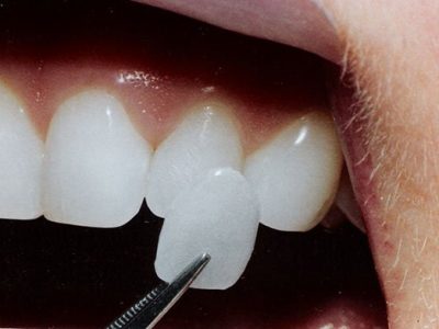 Porcelain Veneers Perth