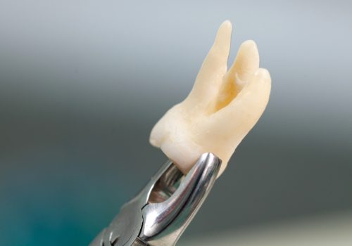 Wisdom teeth removal Applecross