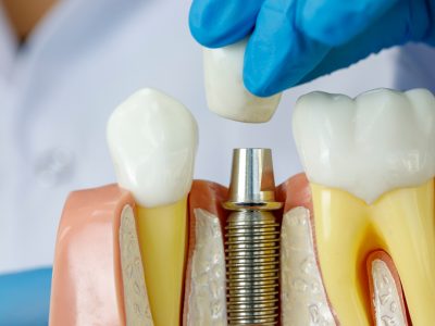 Dental Implants Applecross, Best Cosmetic Dentist Applecross