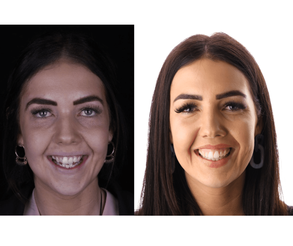 Best Invisalign Perth - Affordable Clear Aligner