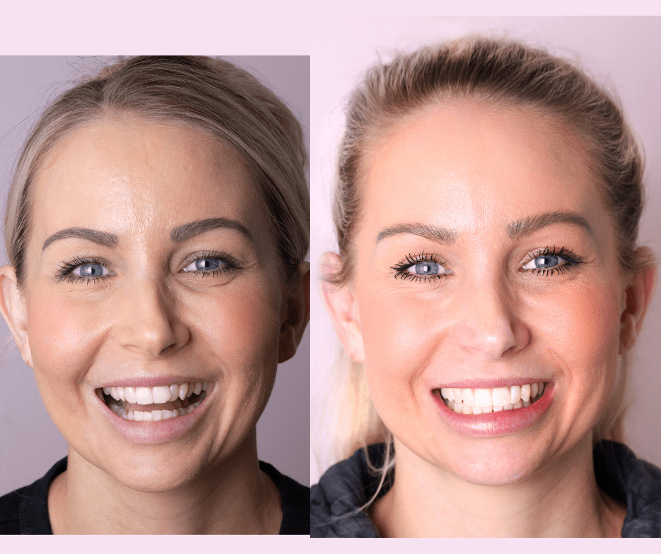 Best Invisalign Perth - Affordable Clear Aligner