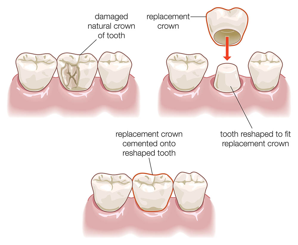 Dental Crown and Bridge Applecross