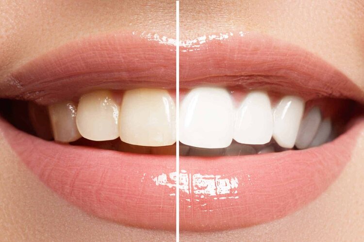 teeth whitening Applecross