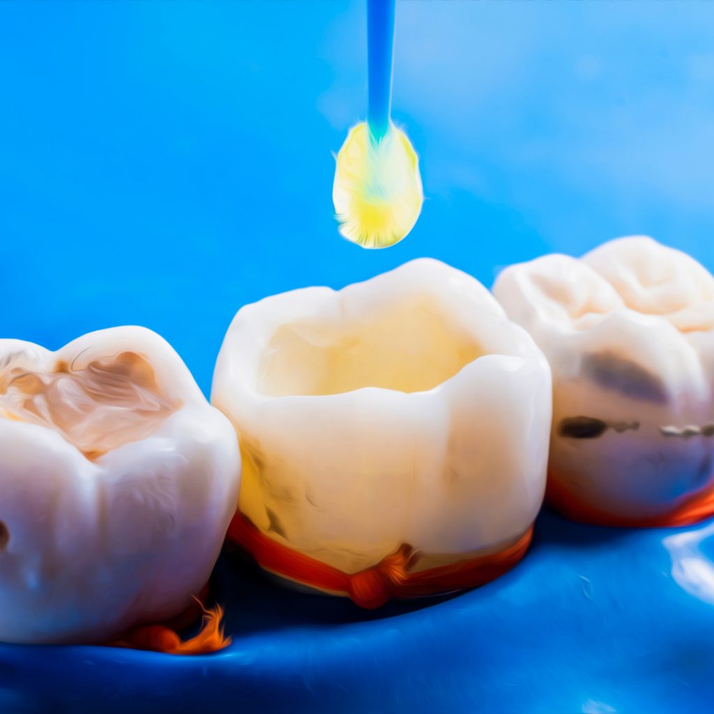 Dental Fillings Applecross