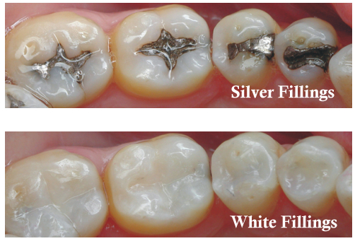 Dental Filling - white and silver fillings