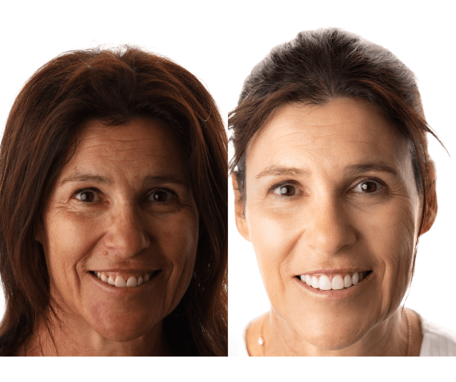 The Applecross Dentist - Before After Dental Veneers Perth