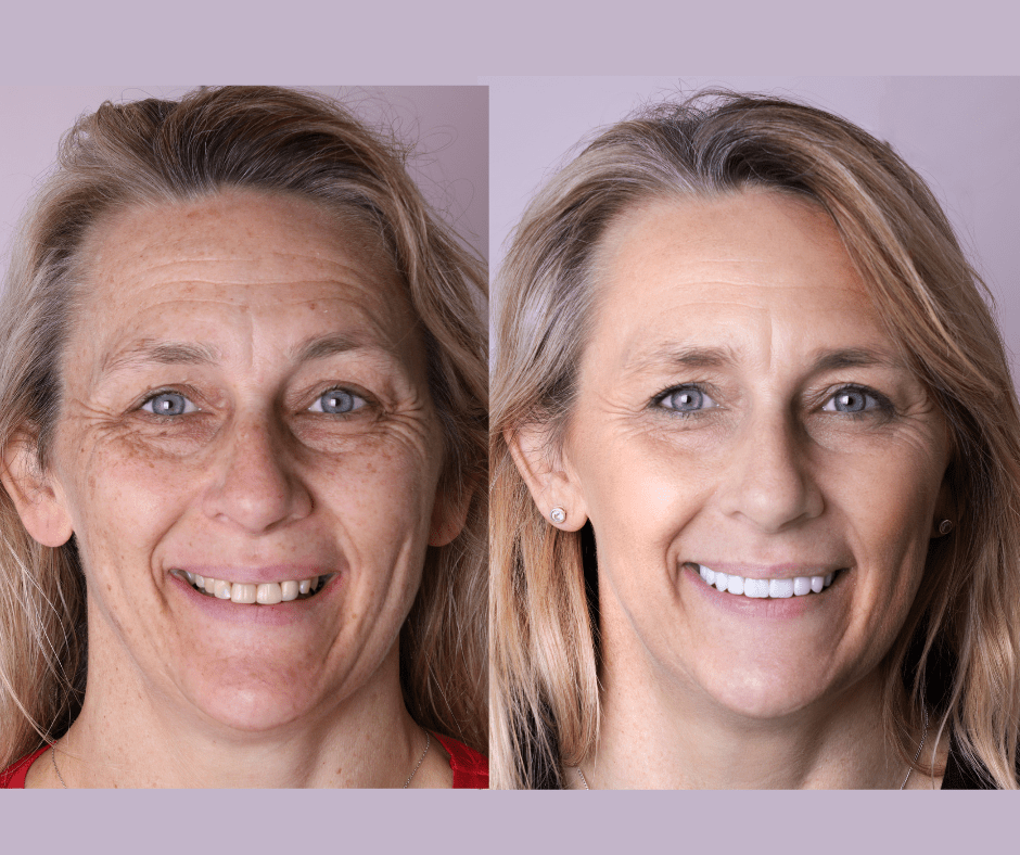 The Applecross Dentist - Before After smile makeover Perth
