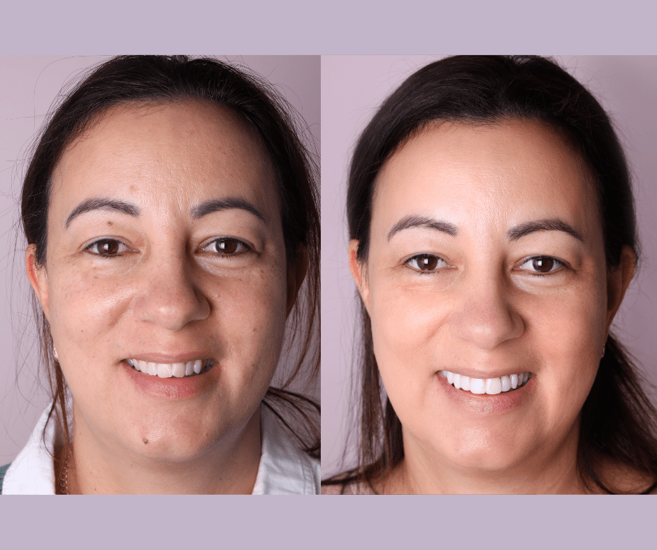 The Applecross Dentist - Before After smile makeover Perth