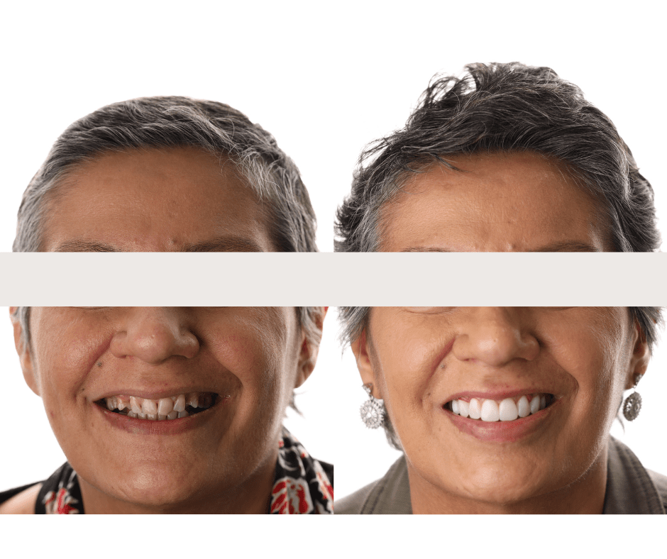The Applecross Dentist - Before After smile makeover Perth WA