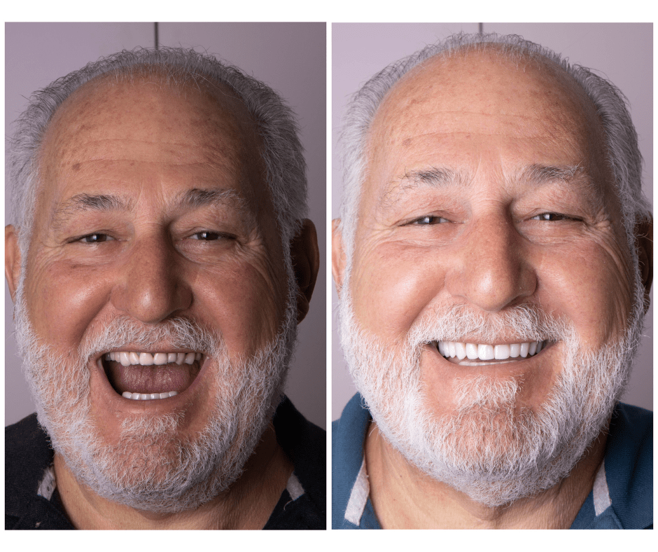 The Applecross Dentist - Before After Dental Veneers Perth WA