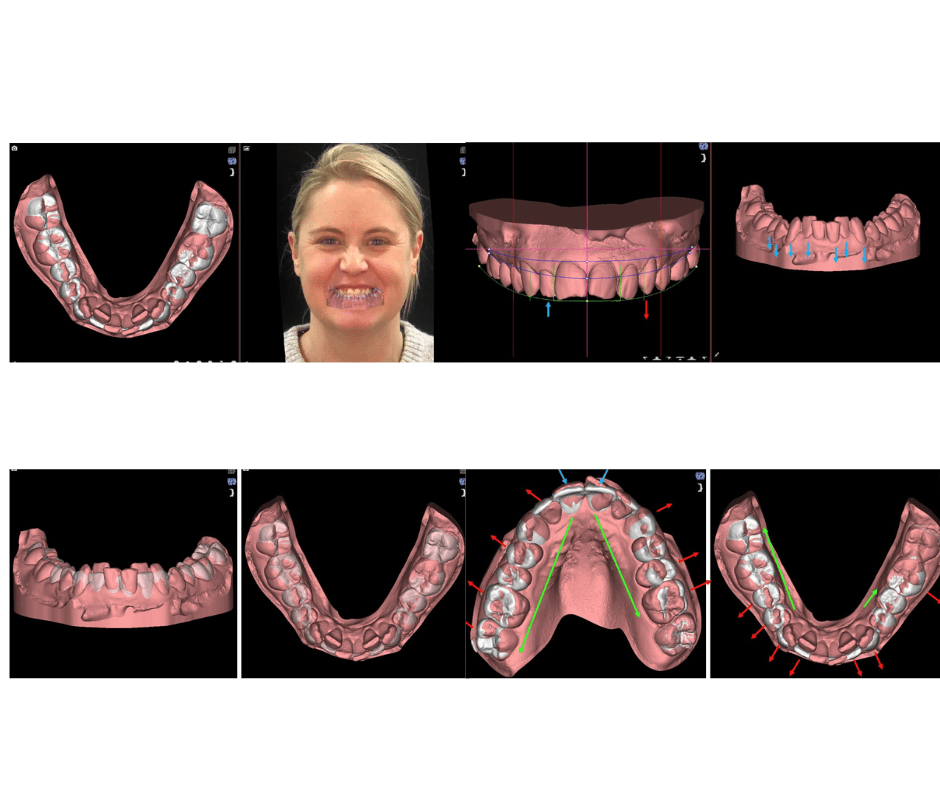 digital smile design perth - treatment process - Cosmetic dentistry