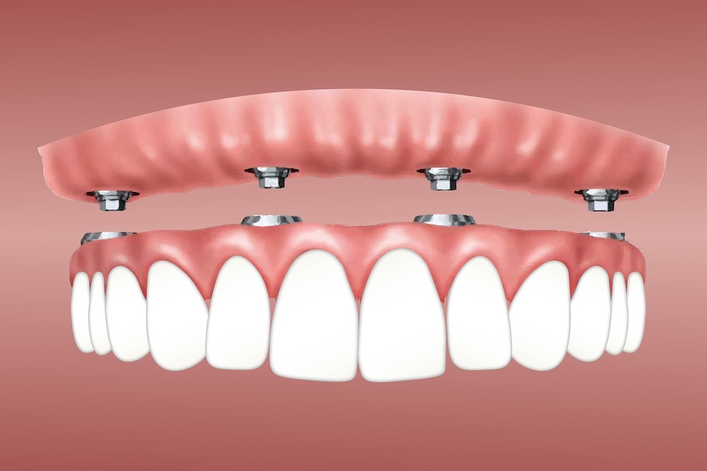 Why All‑on‑4 Dental Implants in Perth Can Transform Your Quality of Life