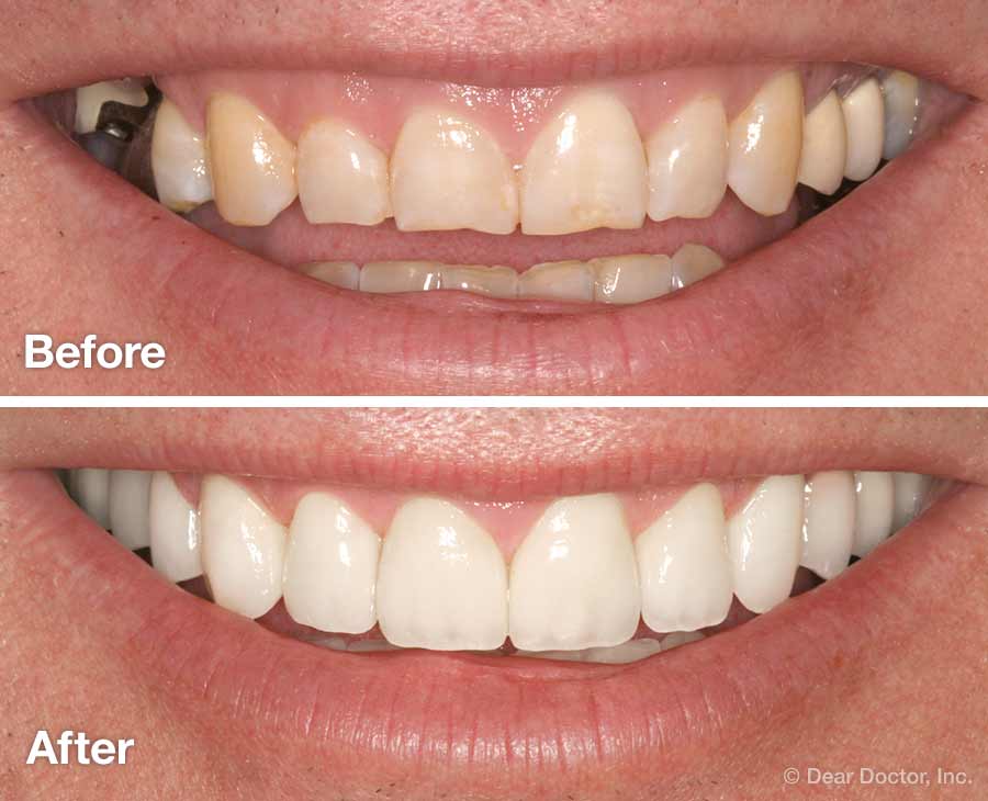 Before-after-digital-smile-design-Applecross and Perth